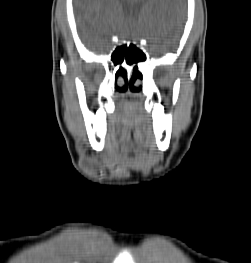Bilateral submandibular sialolithiasis with sialadenitis (Radiopaedia 70721-80881 Coronal non-contrast 5).jpg