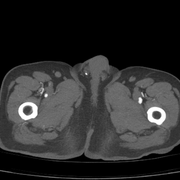 Bilateral superficial femoral arterial occlusion (Radiopaedia 25682-25857 A 32).jpg