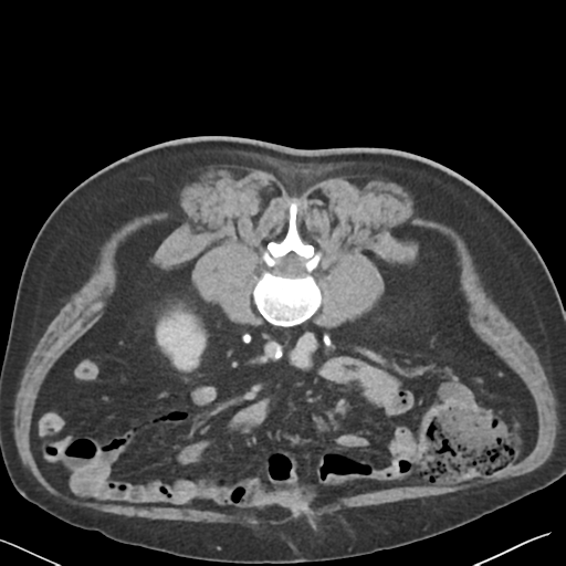 File:Bladder papillary urothelial carcinoma (Radiopaedia 48119-52951 Axial C+ delayed 28).png