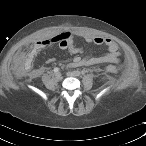 Bladder rupture post renal biopsy (Radiopaedia 30863-31572 Axial non-contrast 55).jpg