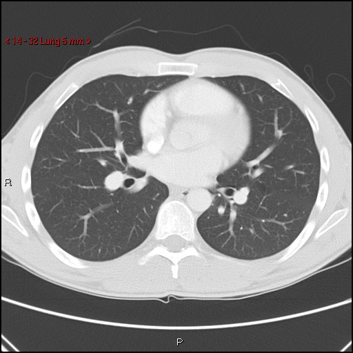 Blunt chest trauma - pulmonary interstitial emphysema and pneumomediastinum (Radiopaedia 20666-20552 Axial lung window 32).jpg