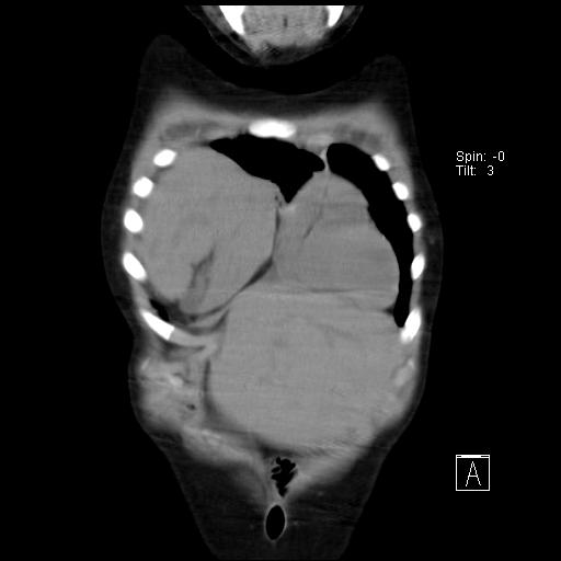 File:Bochdalek diaphragmatic hernia (Radiopaedia 38866-41059 Coronal liver window 4).jpg