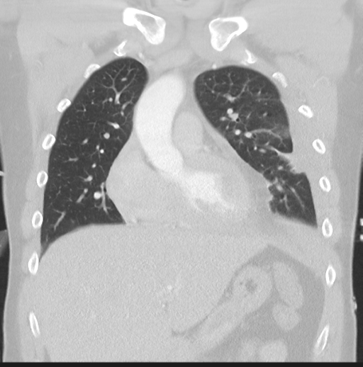 Boerhaave syndrome (Radiopaedia 39382-41661 Coronal lung window 17).png