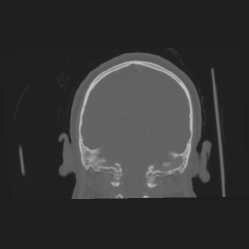 Bone-anchored hearing aid (Radiopaedia 38708-40866 Axial bone window 1).png