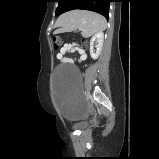 File:Borderline mucinous tumor (ovary) (Radiopaedia 78228-90808 B 26).jpg