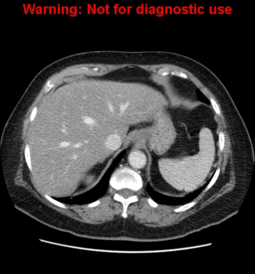 File:Bosniak renal cyst - type II (Radiopaedia 23404-23468 D 14).jpg