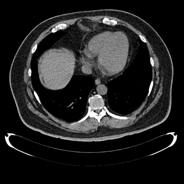Bosniak renal cyst - type IV (Radiopaedia 24244-24518 Axial non-contrast 18).jpg