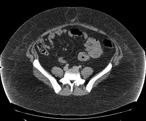 File:Bowel and splenic infarcts in acute lymphocytic leukemia (Radiopaedia 61055-68913 A 88).jpg