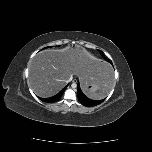 File:Bowel and splenic infarcts in acute lymphocytic leukemia (Radiopaedia 61055-68915 A 22).jpg