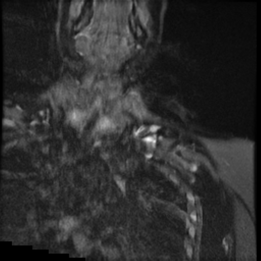 File:Brachial plexus neurofibroma (Radiopaedia 28030-28291 Coronal STIR 14).png
