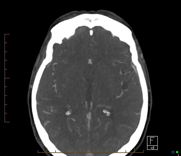 File:Brachiocephalic trunk stenosis (Radiopaedia 87242-103519 A 34).jpg