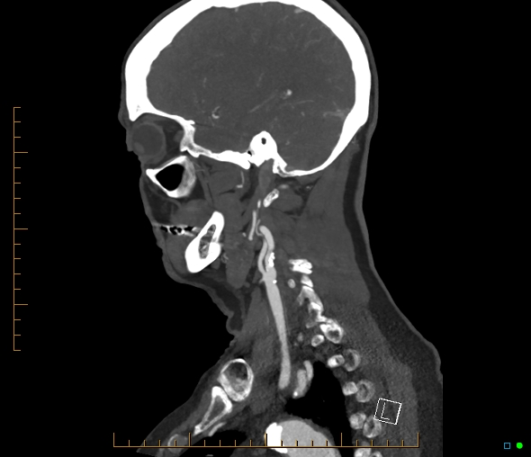Brachiocephalic trunk stenosis (Radiopaedia 87242-103519 C 19).jpg