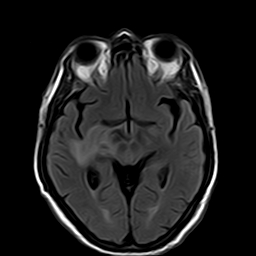 File:Brain abscess complicated by intraventricular rupture and ventriculitis (Radiopaedia 82434-96571 Axial FLAIR 10).jpg