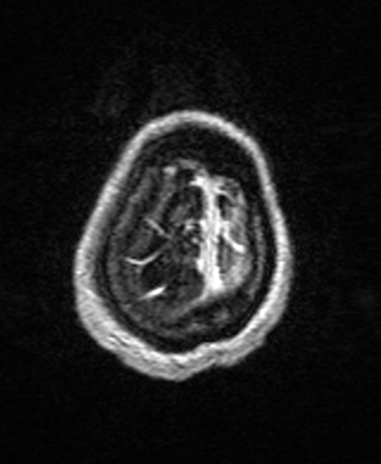Brain abscess with dual rim sign (Radiopaedia 87566-103938 Axial T1 C+ 148).jpg
