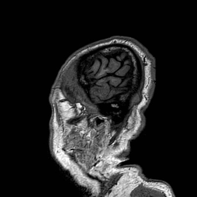 Brain metastases from lung cancer (Radiopaedia 83839-99028 Sagittal T1 123).jpg