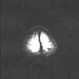 Brainstem glioma (Radiopaedia 67531-76922 Axial DWI 45).jpg