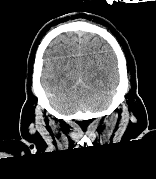 Brainstem hemorrhage (Radiopaedia 81294-94976 Coronal non-contrast 57).jpg