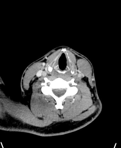 Branchial cleft cyst (Radiopaedia 31167-31875 Axial C+ delayed 41).jpg