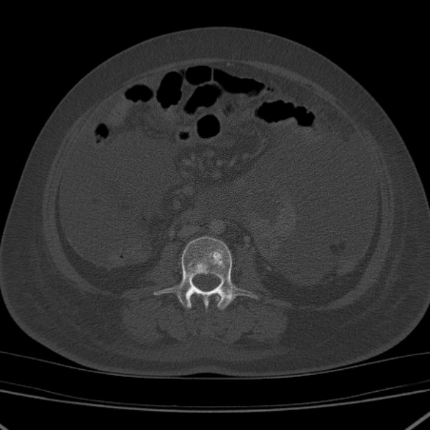 Breast cancer metastases - hepatic and skeletal (Radiopaedia 34201-35461 Axial bone window 66).jpg