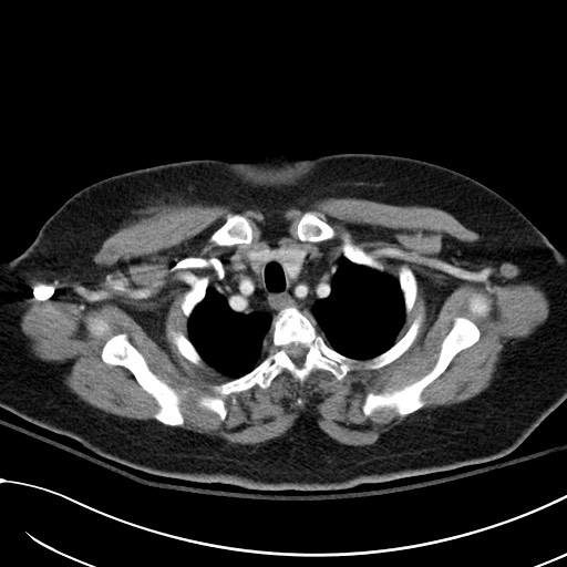 Breast carcinoma with pathological hip fracture (Radiopaedia 60314-67974 A 9).jpg