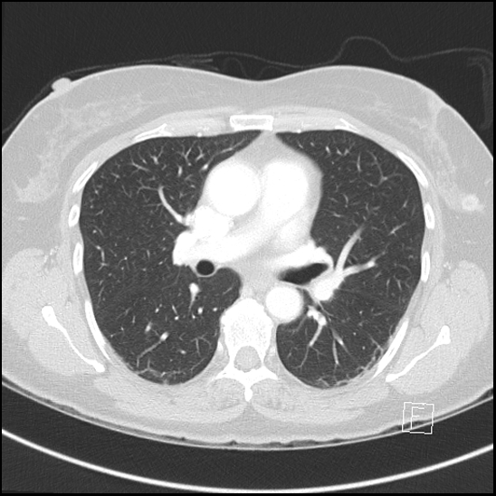 File:Breast metastases from renal cell cancer (Radiopaedia 79220-92225 Axial lung window 39).jpg