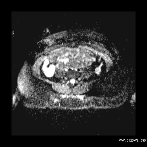 File:Broad ligament fibroid (Radiopaedia 49135-54241 Axial ADC 5).jpg