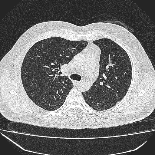 File:Bronchial atresia (Radiopaedia 58271-65417 Axial lung window 18).jpg