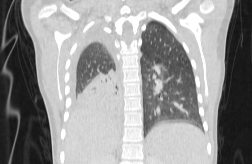 Bronchial mucoepidermoid carcinoma (Radiopaedia 57023-63895 Coronal lung window 63).jpg