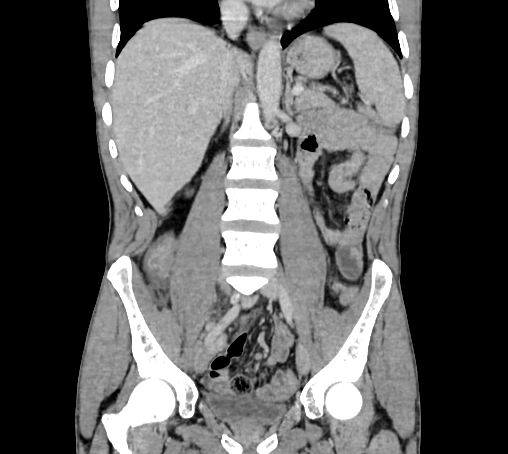 Bronchiectasis in Crohn disease (Radiopaedia 60311-67977 C 43).jpg