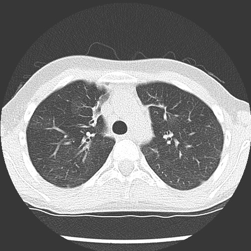 Bronchiolotis obliterans (Radiopaedia 73769-84575 Axial lung window 16).jpg