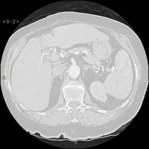 Bronchogenic carcinoma as an incidental finding (Radiopaedia 16453-16130 Axial lung window 2).jpg