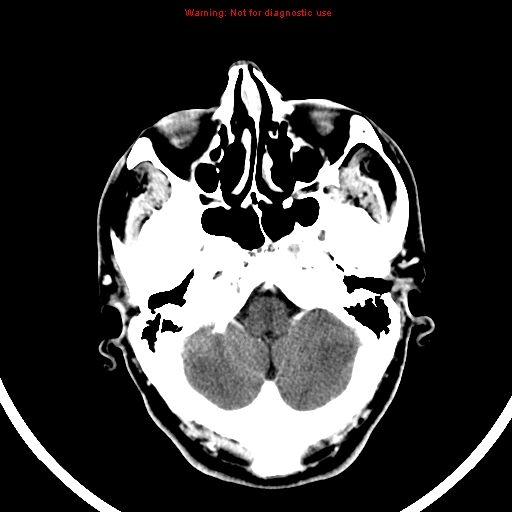 File:Bronchogenic carcinoma brain metastasis (Radiopaedia 9286-9970 B 5).jpg