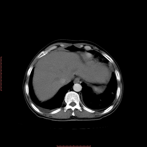 File:Bronchogenic carcinoma with left atrial large deposit - T4N3M1a (Radiopaedia 42316-45428 A 25).jpg