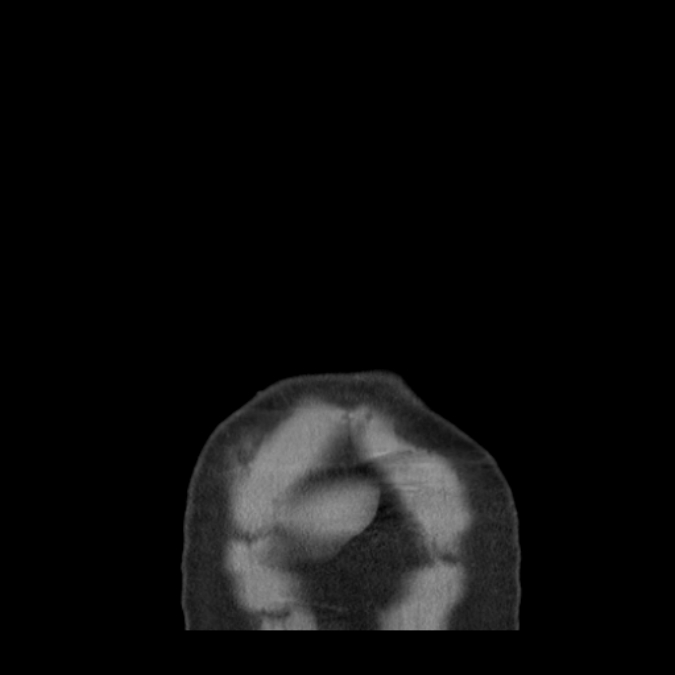 Bronchogenic carcinoma with upper lobe collapse (Radiopaedia 29297-29726 D 2).jpg
