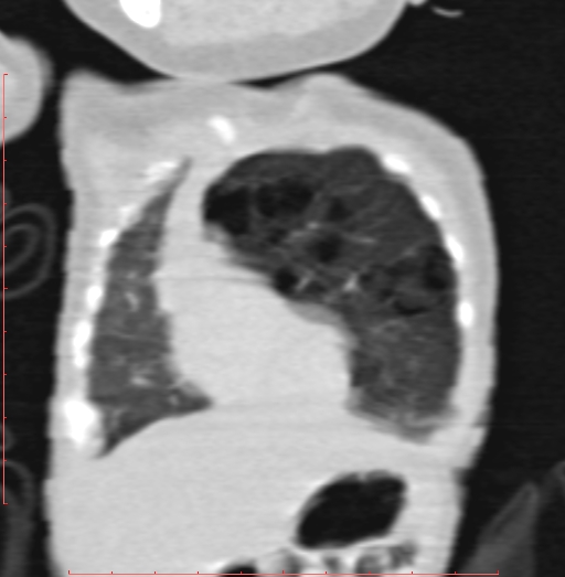 Bronchogenic cyst (Radiopaedia 78599-91409 Coronal lung window 51).jpg