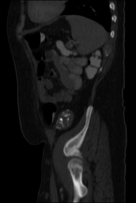 Brown tumors compressing the spinal cord (Radiopaedia 68442-77988 H 44).jpg