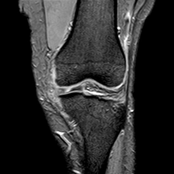File:Bucket handle tear - medial meniscus (Radiopaedia 29250-29664 B 5).jpg