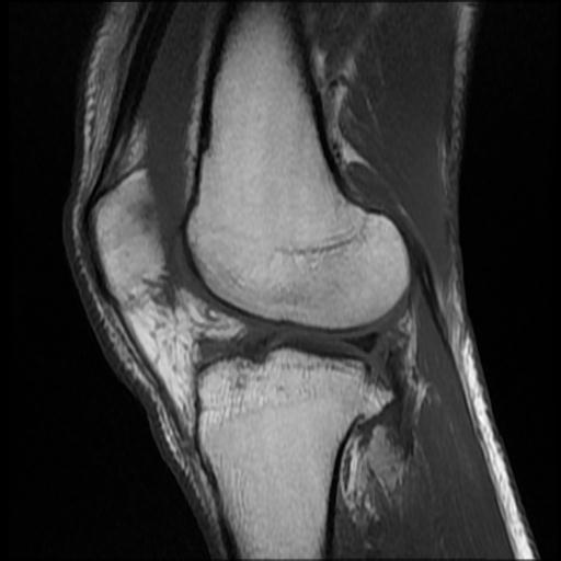 File:Bucket handle tear - medial meniscus (Radiopaedia 69245-79026 Sagittal T1 6).jpg