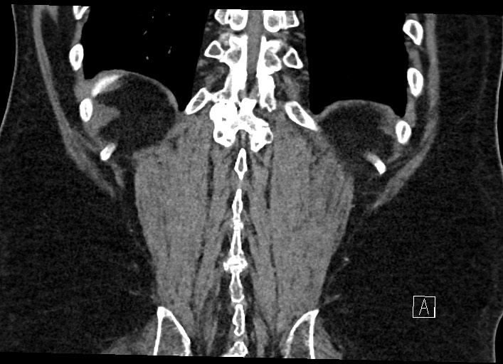 Buried bumper syndrome - gastrostomy tube (Radiopaedia 63843-72577 Coronal Inject 120).jpg