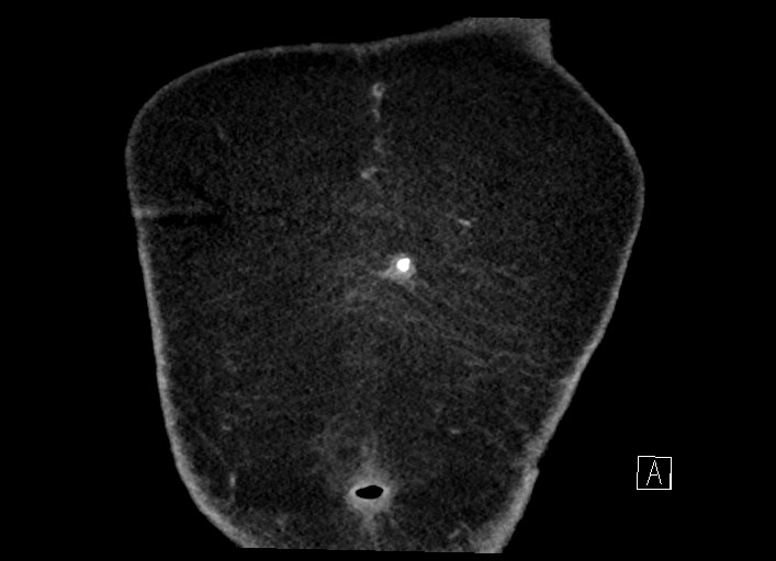Buried bumper syndrome - gastrostomy tube (Radiopaedia 63843-72577 Coronal Inject 3).jpg