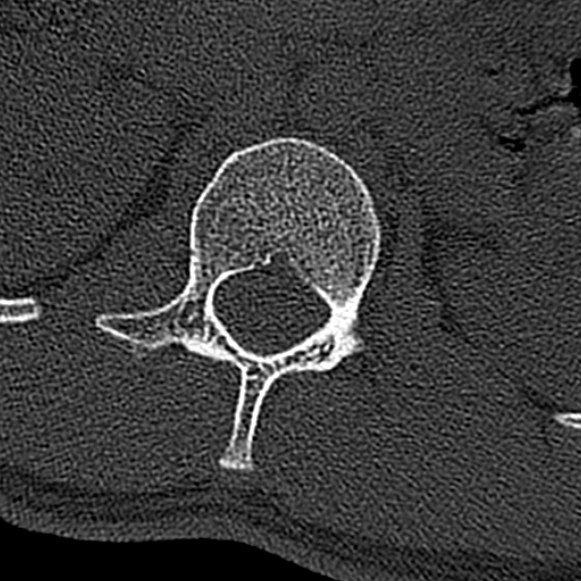 File:Burst fracture (Radiopaedia 53373-59357 Axial bone window 12).jpg