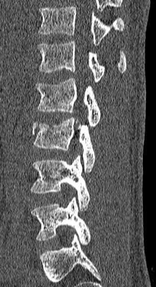Burst fracture (Radiopaedia 53373-59357 Sagittal bone window 22).jpg