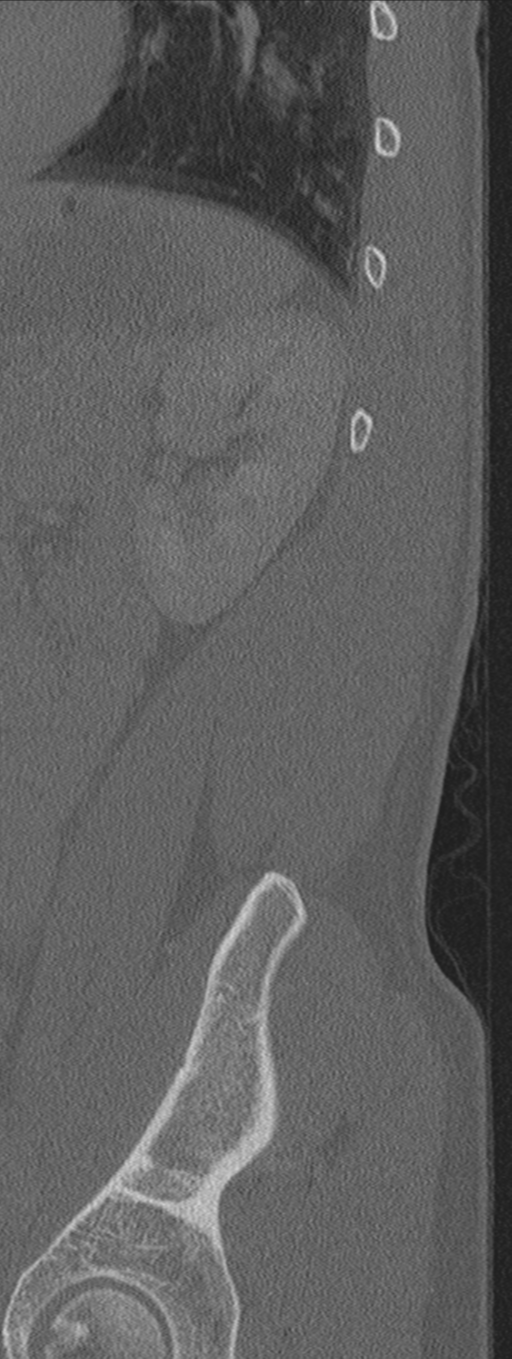 Burst fracture - T12 with conus compression (Radiopaedia 56825-63647 Sagittal bone window 3).png