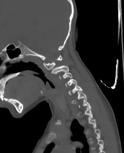 File:Butterfly vertebra (Radiopaedia 77903-90209 Sagittal bone window 21).jpg
