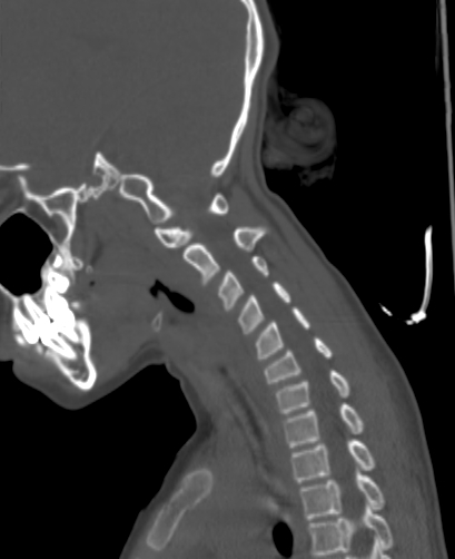 Butterfly vertebra (Radiopaedia 77903-90209 Sagittal bone window 64).jpg