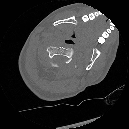 C1-C2 "subluxation" - normal cervical anatomy at maximum head rotation (Radiopaedia 42483-45607 Axial non-contrast 42).jpg