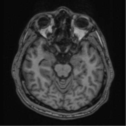 CNS vasculitis (Radiopaedia 55715-62263 Axial T1 7).png