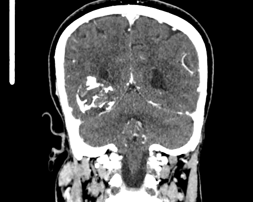 Calcified cerebral hydatid cyst (Radiopaedia 65603-74717 C 52).jpg