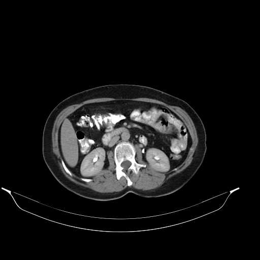 File:Calcified hydatid cyst of the liver (Radiopaedia 21212-21112 Axial C+ delayed 25).jpg