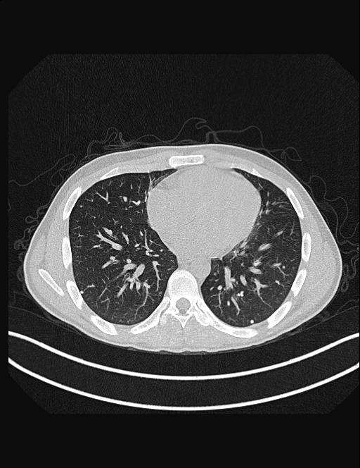 Calcifying pulmonary metastases (Radiopaedia 33359-34396 Axial lung window 41).jpg